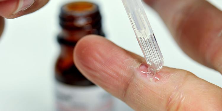 Salicylsäure haltige Arzneien – magistrale Zubereitungen – werden am häufigsten zum Warzen behandeln eingesetzt. © surked / shutterstock.com