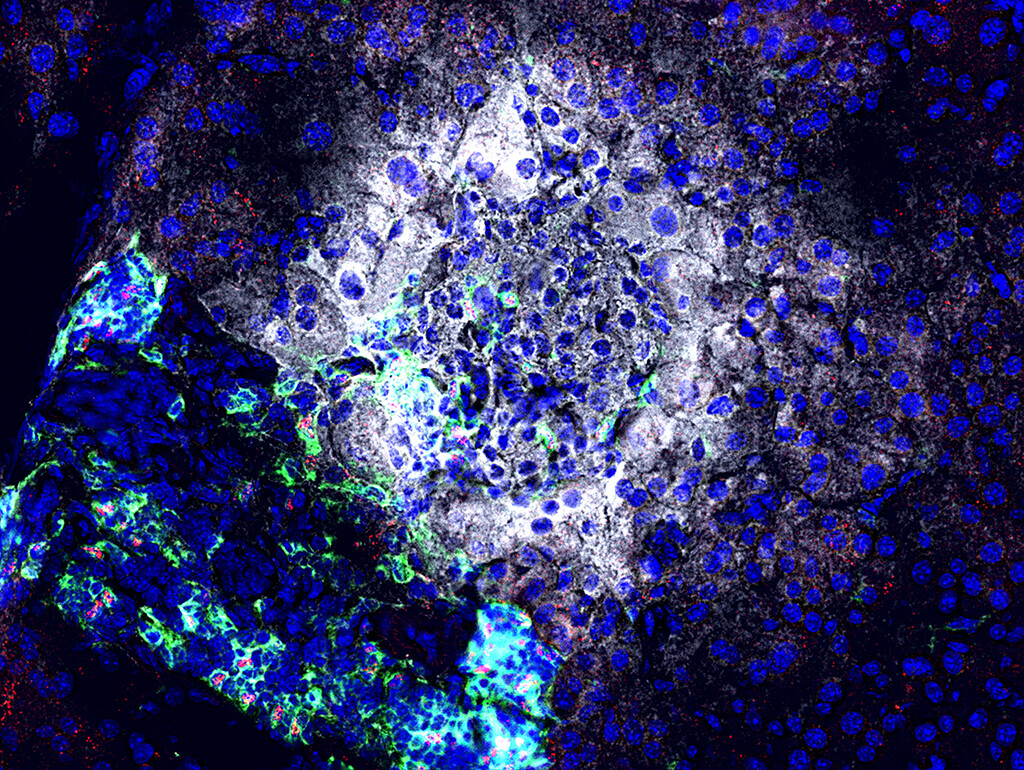 Nach Gabe eines antagomir gegen miR92a werden Insulin (weiß) produzierende Betazellen seltener von Immunzellen (grün) angegriffen. Zudem sind mehr regulatorische T Zellen (rot) vorhanden, die die Betazellen (weiß) schützen können. © Helmholtz Zentrum München