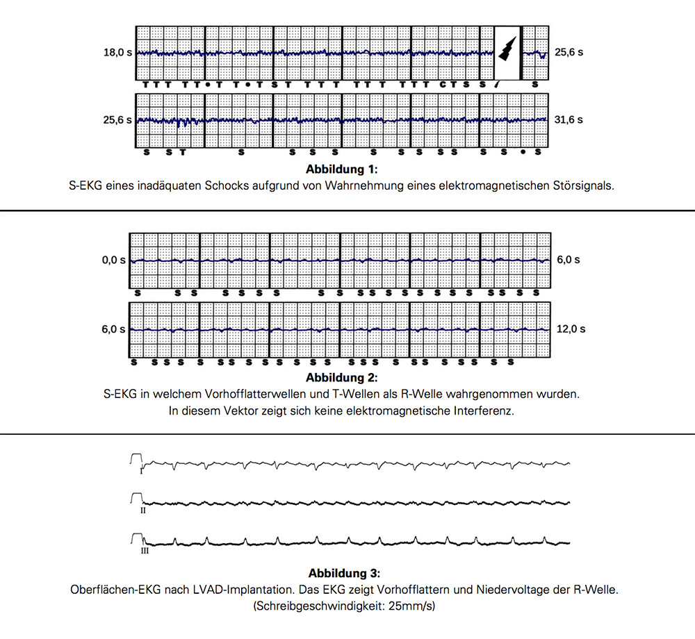 Abbildung 1: S-EKG eines inadäquaten Schocks aufgrund von Wahrnehmung eines elektromagnetischen Störsignals. Abbildung 2: S-EKG in welchem Vorhofflatterwellen und T-Wellen als R-Welle wahrgenommen wurden. In diesem Vektor zeigt sich keine elektromagnetische Interferenz. Abbildung 3: Oberflächen-EKG nach LVAD-Implantation. Das EKG zeigt Vorhofflattern und Niedervoltage der R-Welle. (Schreibgeschwindigkeit: 25mm/s)