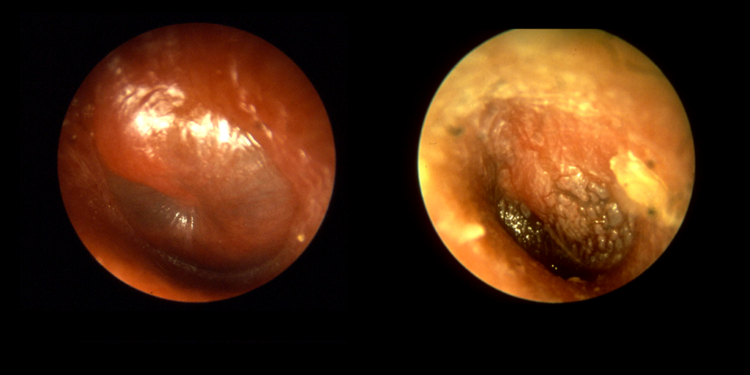Akute Otitis media – Mittelohrentzündung, Links: Entdifferenzierung. Rechts: „schollige Trübung“ des Trommelfelles, linkes Ohr © B. Welleschik / CC BY-SA 3.0 / wikimedia