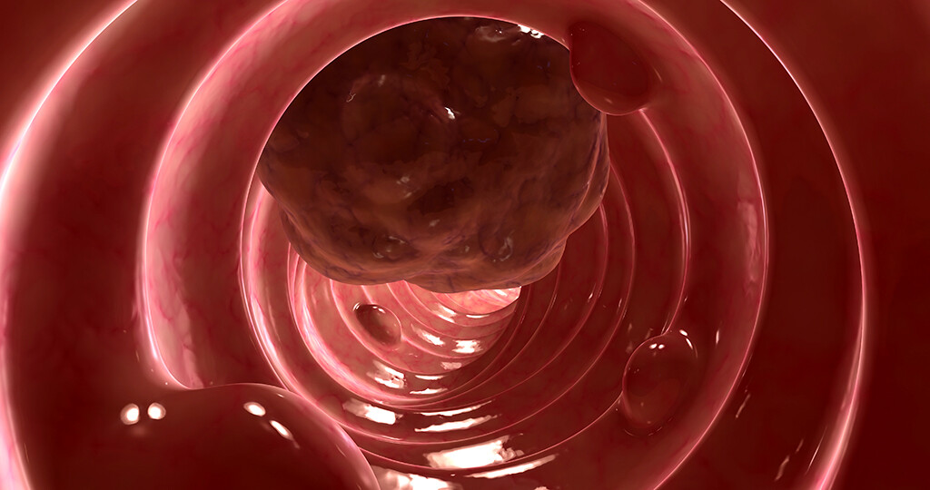 Männer entwickeln häufiger Darmkrebs oder seine Vorstufen als Frauen. © sebastian kaulitzki / shutterstock.com