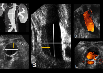 Abbildung 1 A–E: Typisches infrarenales Bauchaortenaneurysma mit übersichtlicher Darstellung im Angio-CT (A). Derselbe Befund in der sagittalen Schnittebene im Ultraschall (B) und axial geschnitten (C). Besonders gut ist der Thrombussaum des Aneurysmasackes im Ultraschall zu erkennen (gelbe Linie). Dieser wird nicht durchblutet, was wiederum mittels Power-Doppler in sagittaler (D) und axialer Orientierung (E) dargestellt wird.