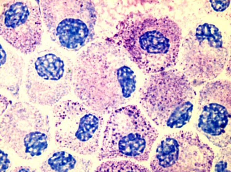 CCL-2-Spiegel Und Systemische Mastozytose - MedMix