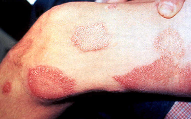 Was Ist Lepra Für Eine Krankheit Lepra-Krankheit weltweit unter Kontrolle - MedMix