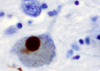α-Synuclein-Färbung eines Lewy-Körperchens in der Substantia nigra bei Parkinson-Erkrankung. © Marvin 101 / CC BY-SA 3.0