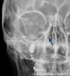 Abbildung 2: Implantat mit Elektrode (Pfeil) am Sphenopalatine ganglion.
