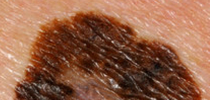 Hautkrebs © afcom.at