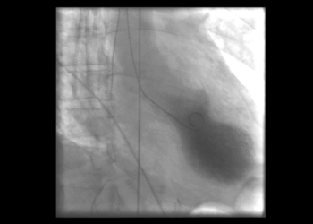 Ventrikulografie der linken Herzkammer bei einer Stress-Kardiomyopathie © Tara C Gangadhar, Elisabeth Von der Lohe, Stephen G Sawada and Paul R Helft / CC BY 2.0 / wikimedia