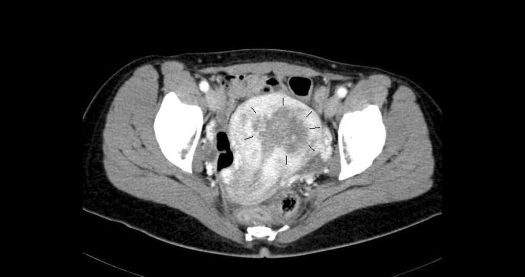 Endometriumkarzinom im CT. © MBq Disk / wikimedia