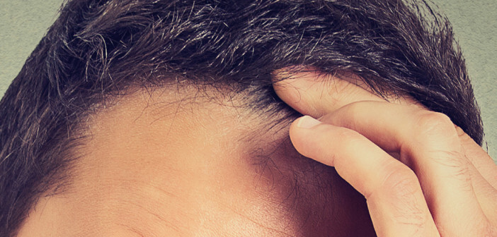 Androgenetischer Haarausfall – anlagebedingter Haarausfall.
