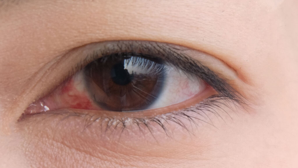 Trockene Augen (Sicca Syndrom) verursachen ein Gefühle wie Sankörner in den Augen zu haben. © Lennon Photo / shutterstock.com