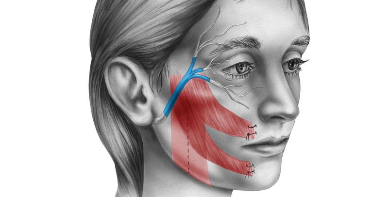Idiopathische Fazialisparese Bell’s Palsy, häufige Gesichtslähmung