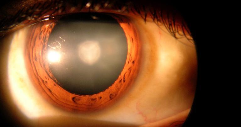 Katarakt-Operation: Intraokularlinsen mittels OP implantieren