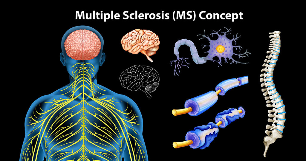 Multiple Sklerose © BlueRingMedia / shutterstock.com