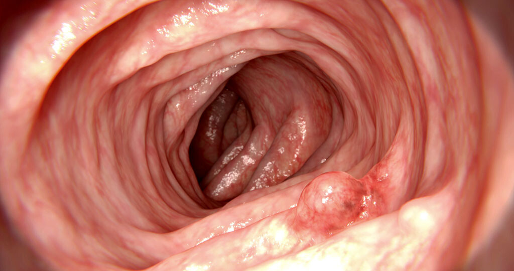 Darmkrebsvorsorge – Darmkrebs-Vorstufen: Polyp – Adenom © Juan Gaertner / shutterstock.com
