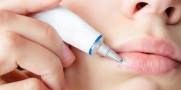 Fieberblasen – Lippenherpes oder auch Herpes labialis genannt – kann vor allem in der Anfangsphase effektiv mit sogenannten Virustatika behandelt werden. © ECOSY / shutterstock.com