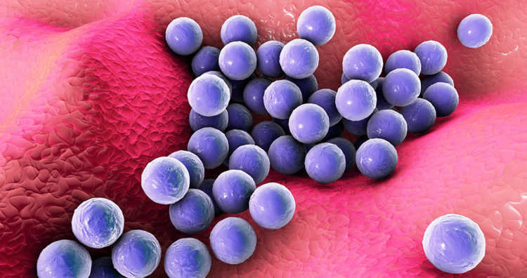 Staphylococcus aureus bei Neurodermitis verschlechtern die Krankheit
