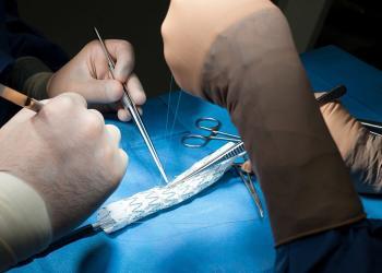 Anfertigung der individualisierten Stentprothese. © Klinikum der Universität München /OP Fotos Tsilimparis