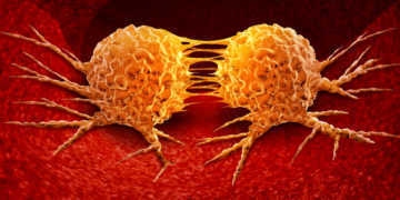 Metastasenbildung / Krebszellen / Metastasen © Lightspring / shutterstock.com