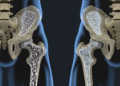 Die Osteoporose entsteht aus einem Missverhältnis zwischen Knochenab- und -aufbau, dadurch kommt es zu Veränderungen der Knochenmasse und der Mikroarchitektur des Knochengewebes. © Javier Regueiro / shutterstock.com