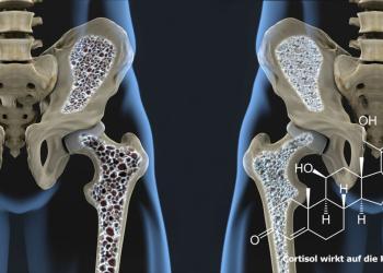 Cortisol kann auch zu krankhaften Knochenschwund führen. Dabei kann eine Glukokortikoid-Therapie eine sekundäre Osteoporose verursachen. © Javier Regueiro / shutterstock.com