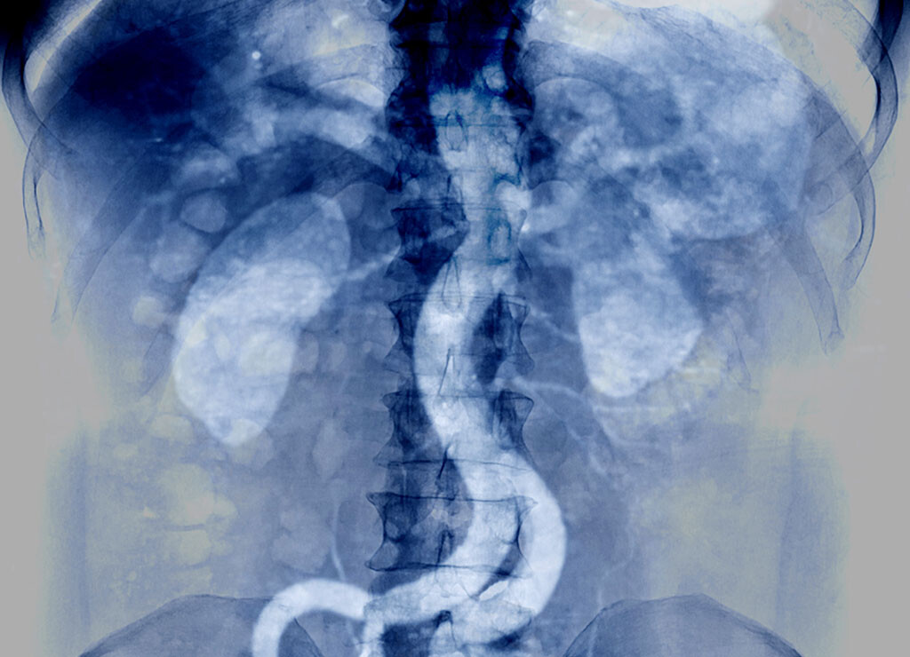 Die Möglichkeit, dass die Aorta reißt, ist die gefährlichste Komplikation beim Ehlers-Danlos-Syndrom. © samunella / shutterstock.com