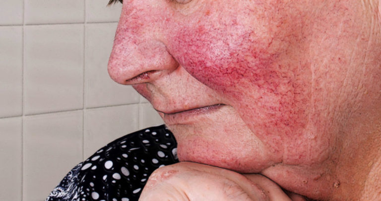 Die Hautkrankheit Rosacea Früh Erkennen Und Wirksam Behandeln