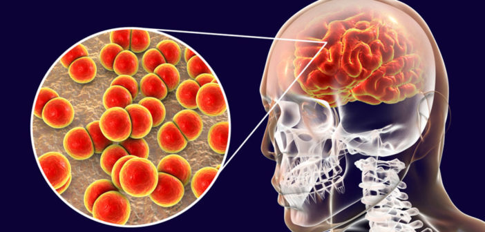 Bakterielle Meningitis durch Pneumokokken gehören weltweit zu den häufigsten Infektionskrankheiten. © Kateryna Kon / shutterstock.com