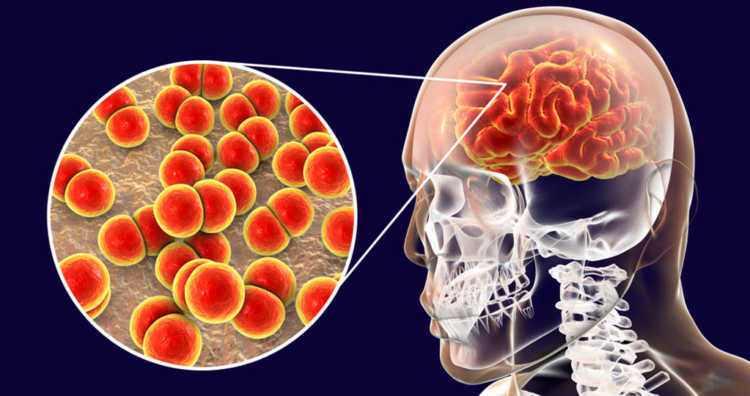Neue Überlebensstrategien Pneumokokken bei Meningitis haben