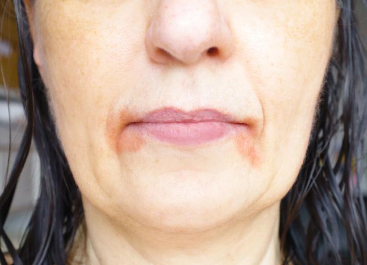 Richtige Pflege der Haut bei perioraler Dermatitis, Mundrose