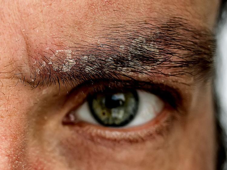 Zusammenhang Psoriasis vulgaris und VitaminDMangel