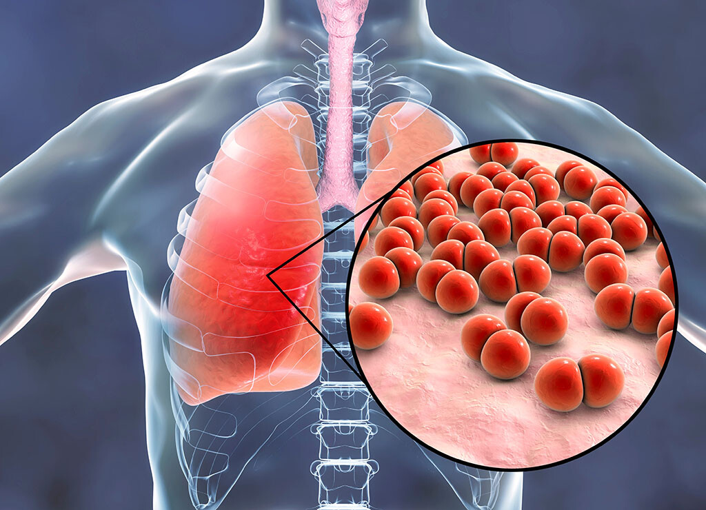 Pneumokokken-Pneumonie: Bakterien verursachen eine Lungenentzündung. © Kateryna Kon / shutterstock.com