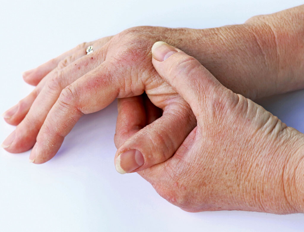 Neue wirksame Medikamente gegen Psoriasis Arthritis verbessern das Leben der Patienten beträchtlich. © Astrid Gast / shutterstock.com