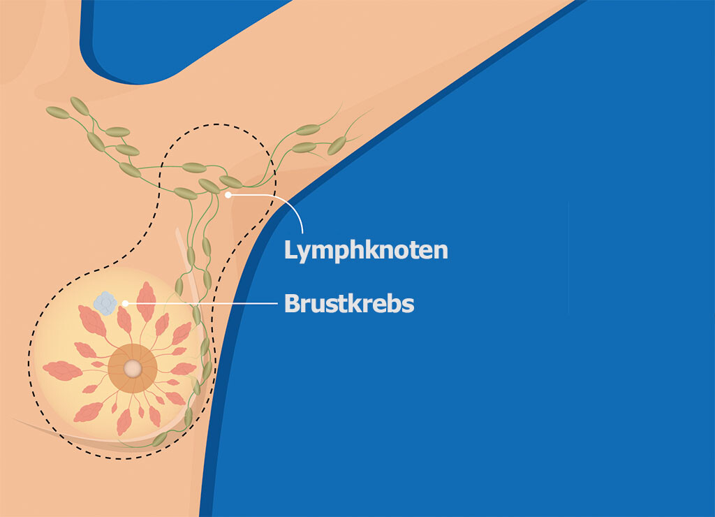 Brustkrebs mit Lympfknotenbefall © Illustration rumruay / shutterstock.com