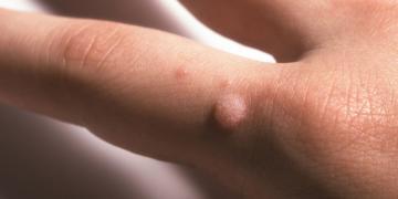 Warzen sind Hautinfektionen mit humanen Papillomaviren (HPV), die meist gutartig sind und machen nur selten ernsthafte Symptome verursachen. © LenaProkopenko / shutterstock.com