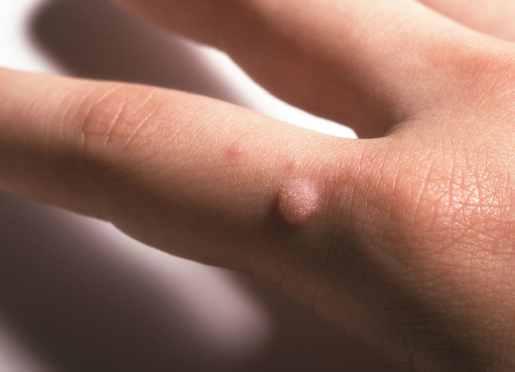 Warzen sind Hautinfektionen mit humanen Papillomaviren (HPV), die meist gutartig sind und machen nur selten ernsthafte Symptome verursachen. © LenaProkopenko / shutterstock.com