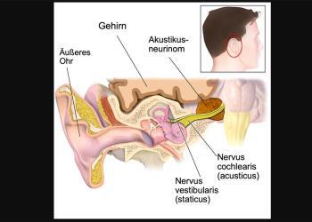 Typische anatomische Lage des Akustikusneurinoms © Partynia / wikimedia / CC BY-SA 4.0
