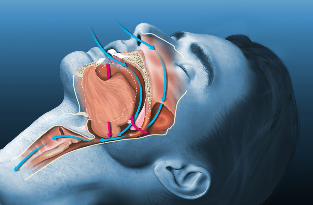 Medizinisch 3D-Illustration zeigt einen schlafenden Schnarchen © Axel_Kock / shutterstock.com